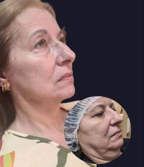 Antes e Depois 3
